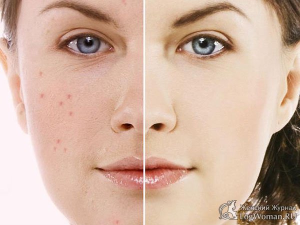 Лечение угревой сыпи на лице Лечение угревой сыпи на лице