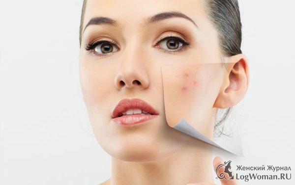 Как избавиться от прыщей в домашних условиях