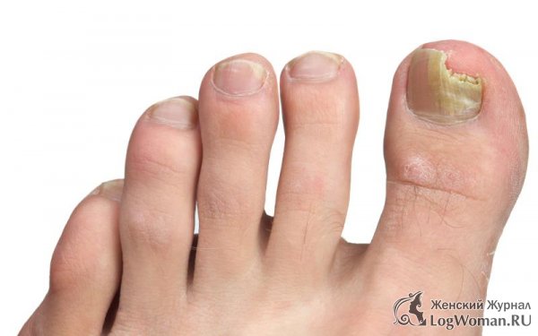 Как вылечить грибок на ногах?  Как вылечить грибок на ногах?