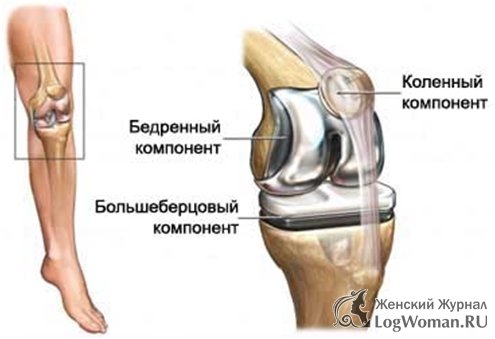 Этапы замены коленного сустава