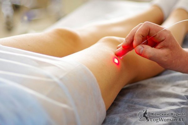 Лазерное лечение варикоза Лазерное лечение варикоза