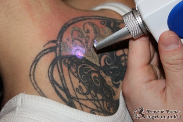 Как происходит процедура удаления татуировок лазером? Как происходит процедура удаления татуировок лазером?