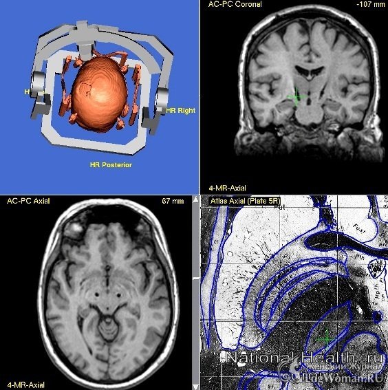 Хирургические методы лечения болезни Паркинсона