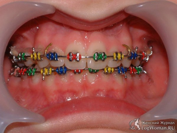 Все самое важное о брекетах