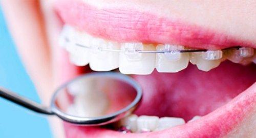 Установка брекетов: показания к установке