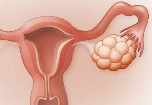 Беременность при СПКЯ – алгоритм успешного лечения