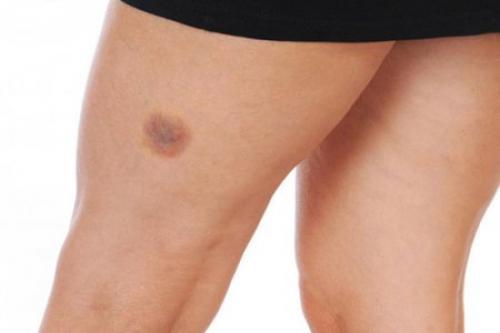 Синяки на ногах без причины у женщин