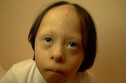 Очаговая алопеция у детей