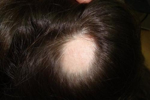 Очаговая алопеция – почему появляется гнездное выпадение волос и что с этим делать