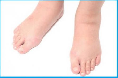 Почему появляются отеки ног у женщин