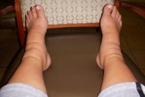 Почему отекают отекают нижние конечности – причины