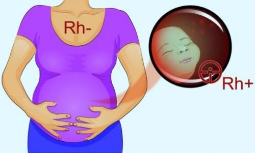 Последствия резус-конфликта для ребенка – исходы и профилактика