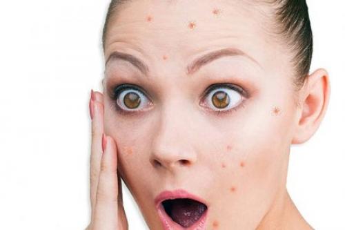 Какие прыщи нельзя давить