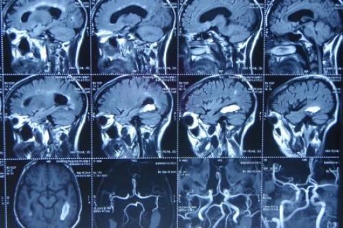 Немедленно в больницу! Симптомы приближающегося инсульта