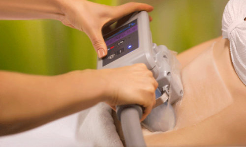 Криолиполиз