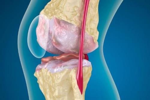 Что такое гонартроз коленных суставов?