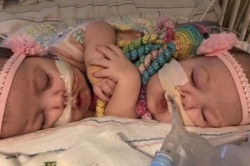 В США раздели сиамских близнецов, сросшихся животами